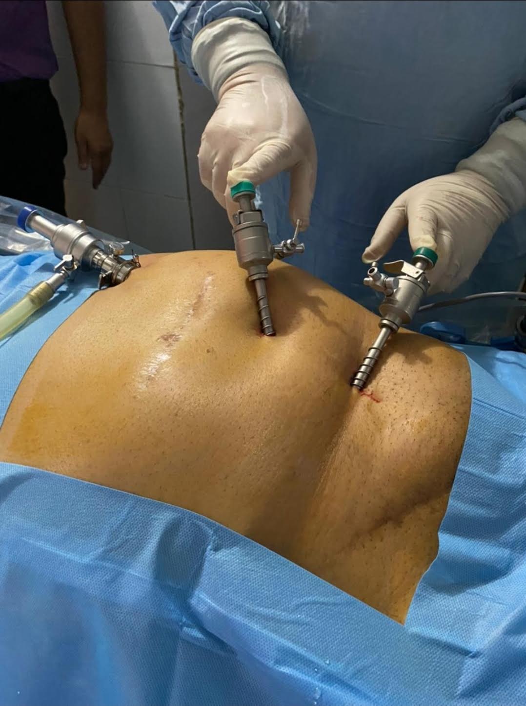 Laparoscopic Hernia surgery